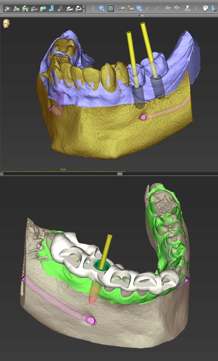 Computerbilder und Screenshots bei der Navigierten Implantologie mittels 3D-Röntgen
