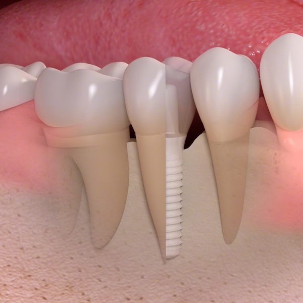 Keramikimplantate, Vöcklabruck 