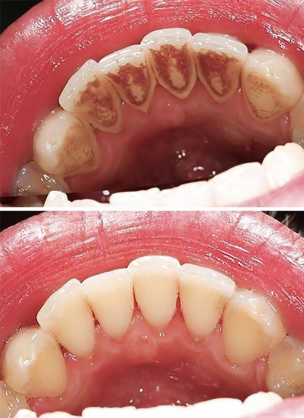 Vorher-Nachher Bild einer Zahnreinigung bzw. Zahnprophylaxe